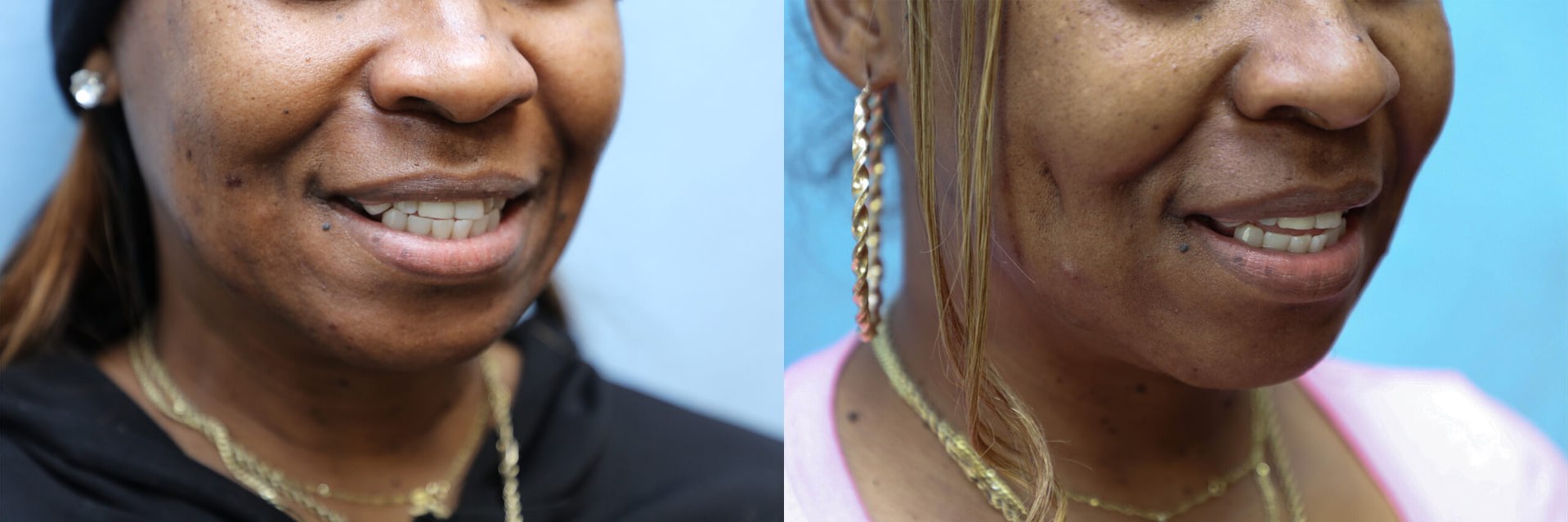 Dimpleplasty Before & After Photos