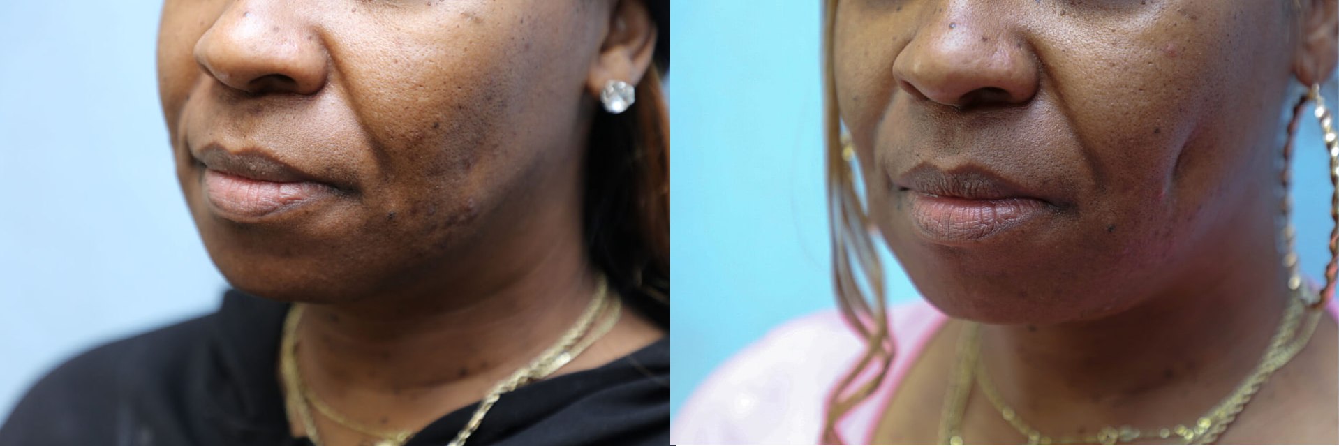 Dimpleplasty Before & After Photos