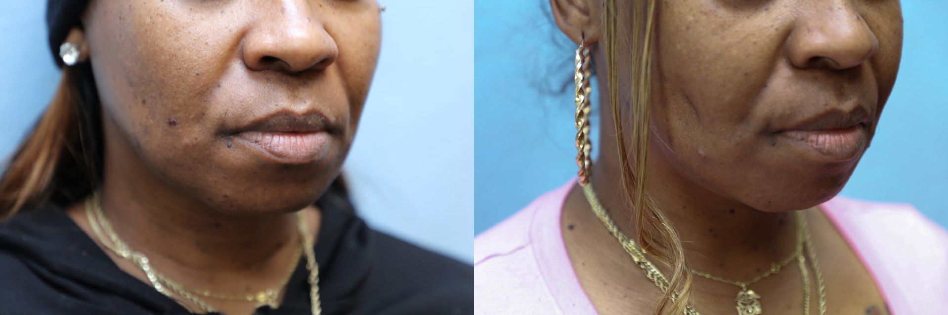 Dimpleplasty Before & After Photos