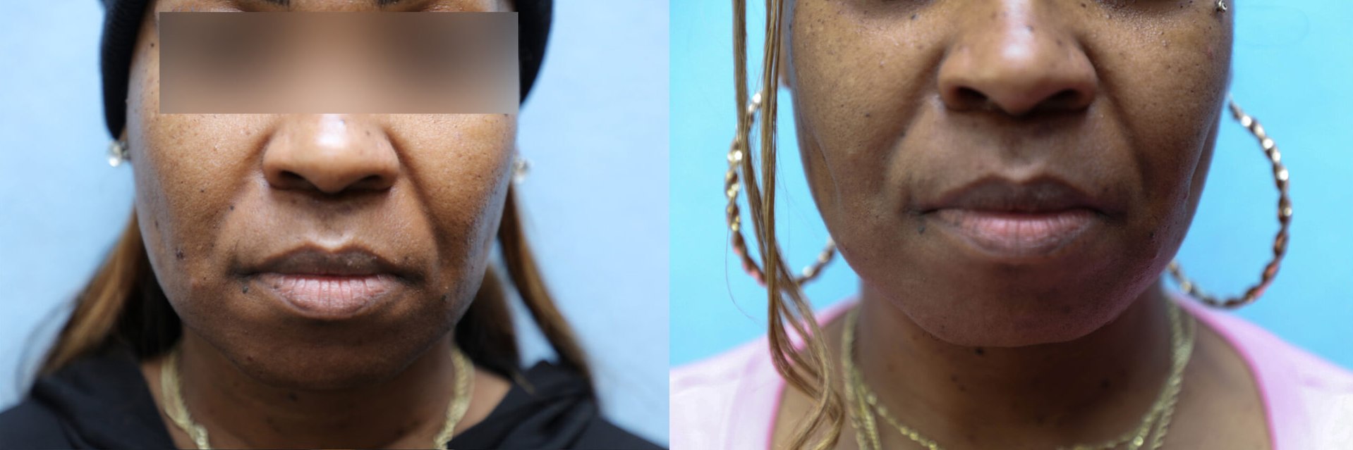 Dimpleplasty Before & After Photos