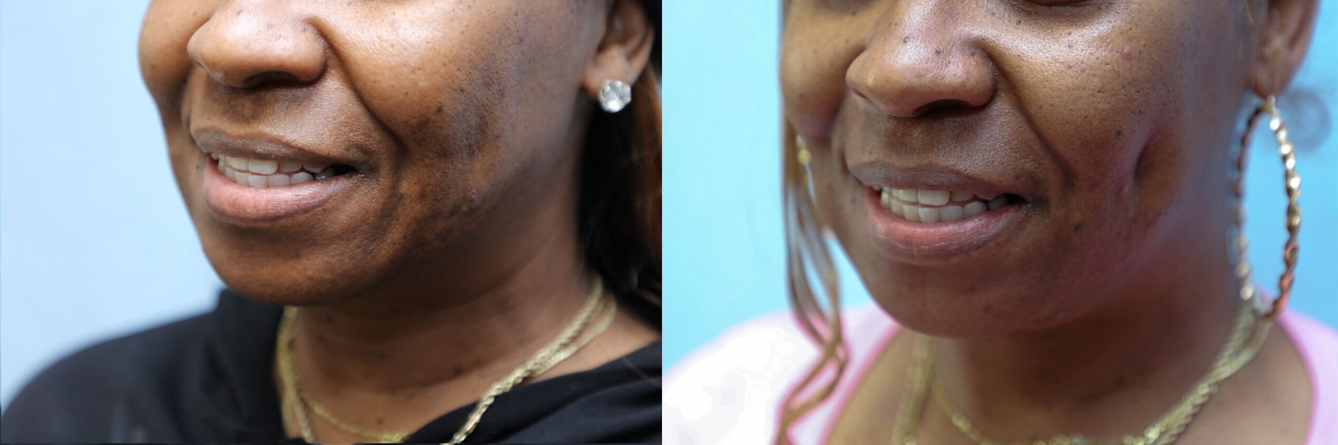 Dimpleplasty Before & After Photos