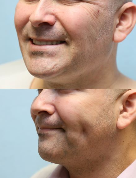 dimpleplasty before and after photos