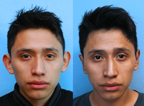 Ear Pinning for Men Before & After Photos