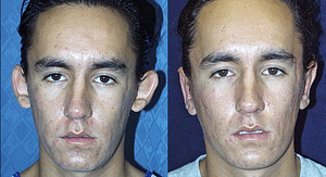Ear Pinning for Men Before & After Photos