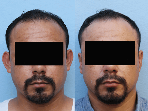 Ear Pinning Orange County Before & After Photos