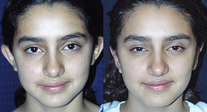 Ear Pinning Before and After Orange County