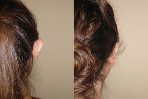 Ear Pinning Before and After Orange County