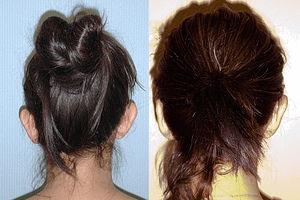 Ear Pinning Before and After Orange County