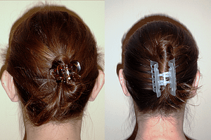 Ear Pinning Before and After Orange County