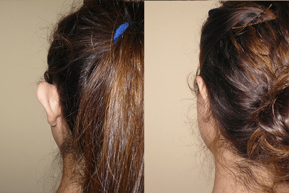 Ear Pinning Before and After Orange County