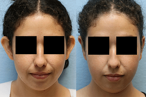 Ear Pinning Before and After Orange County