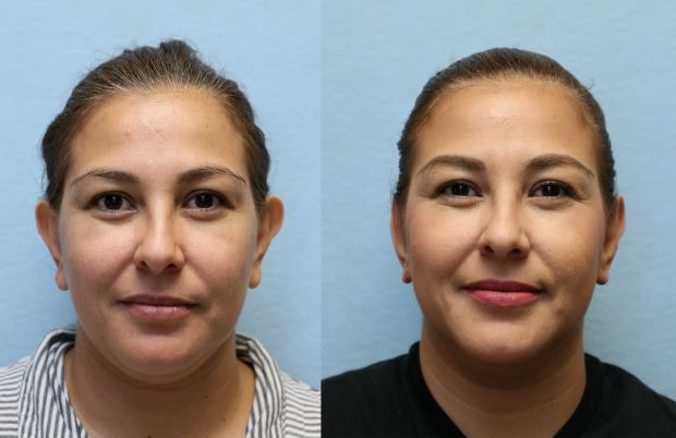 Ear Pinning Before and After Orange County