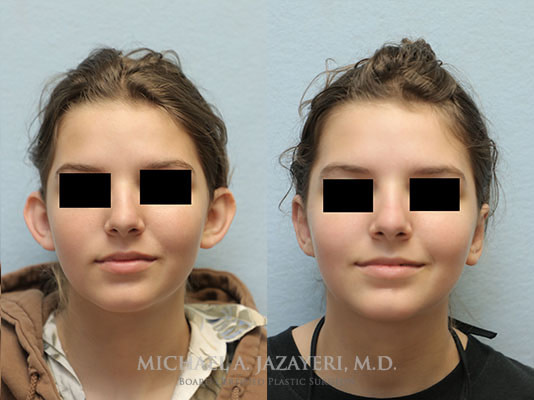 otoplasty before and after