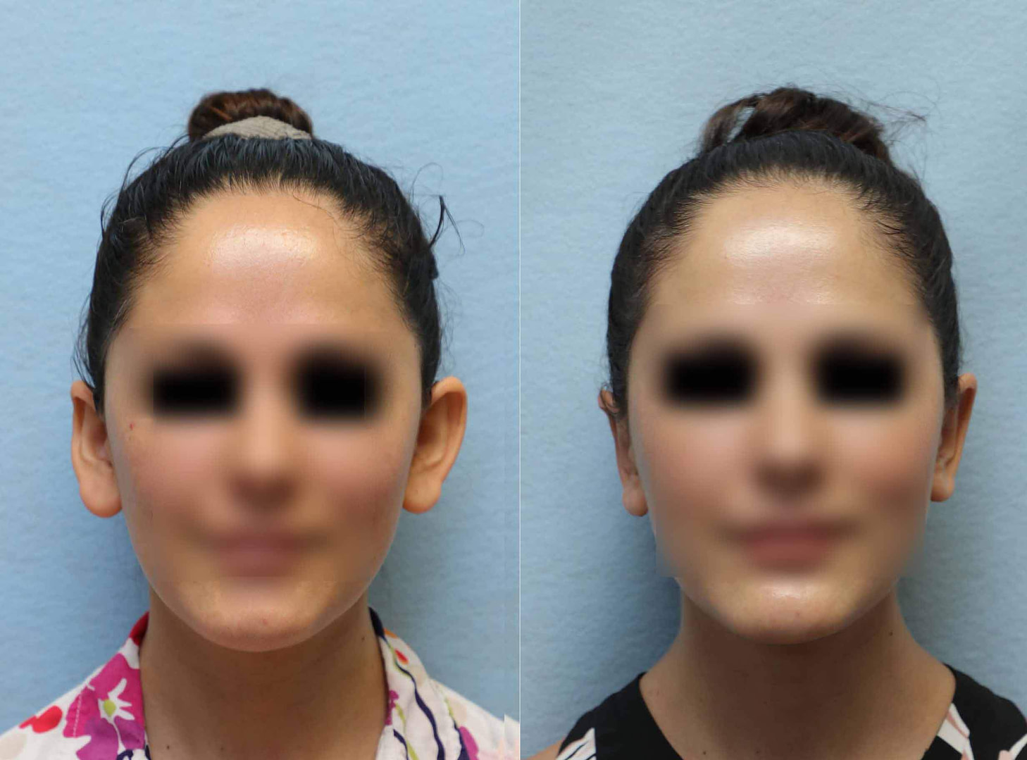 Ear Pinning Before and After Orange County