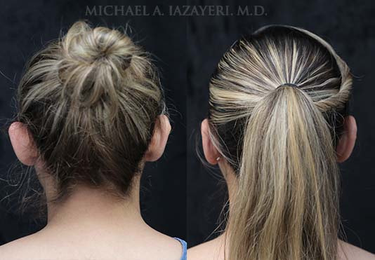 Ear Pinning Before and After Orange County