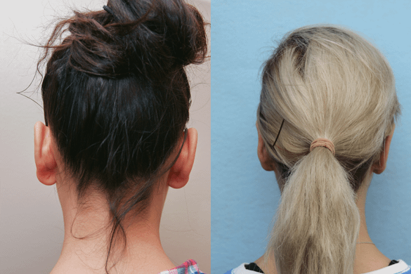 Ear Pinning Before and After Orange County