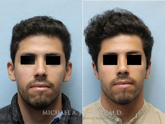 Ear Pinning Before and After Orange County