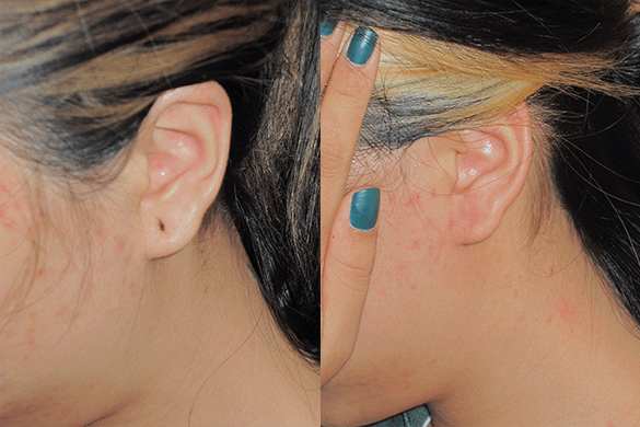 Earlobe Repair Before & After
