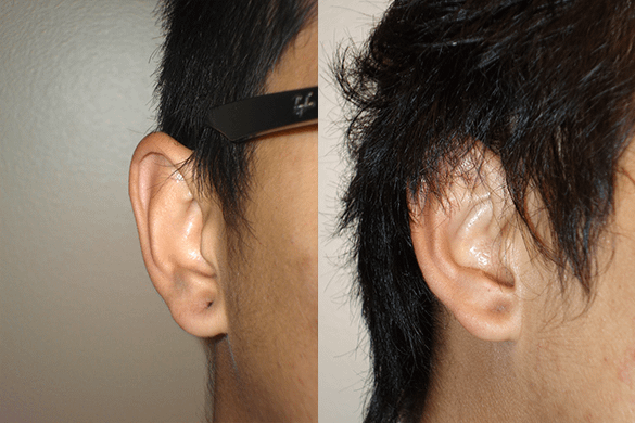 Earlobe Repair Before & After Photos