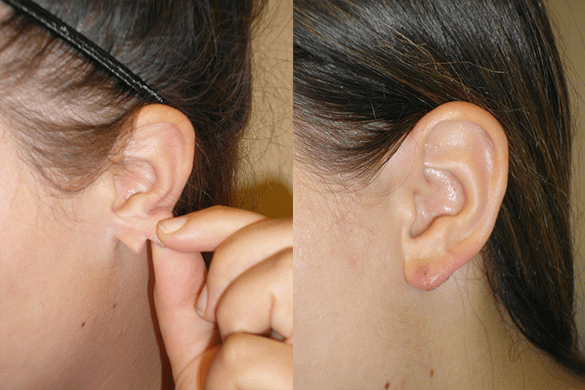 Earlobe Repair Before & After Photos