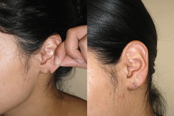 Earlobe Repair Before & After Photos