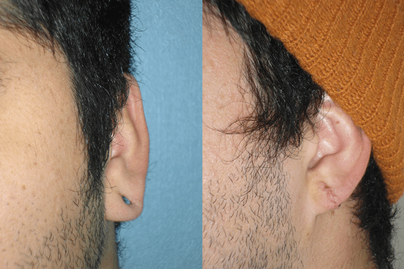 Earlobe Repair Before & After Photos Right