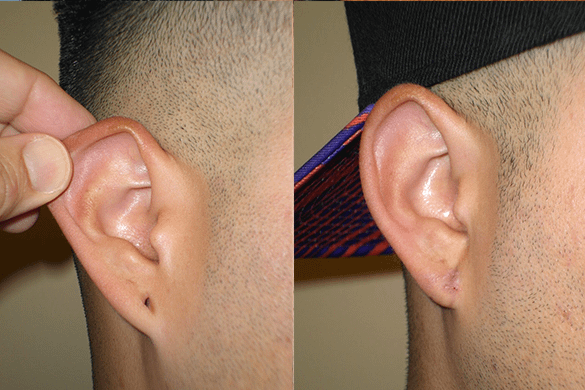 Earlobe Repair Before & After