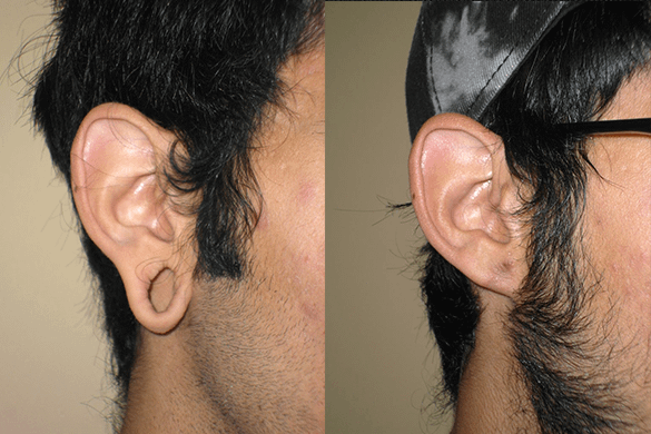 Earlobe Repair before and after