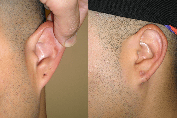 Earlobe Repair Before & After Photos