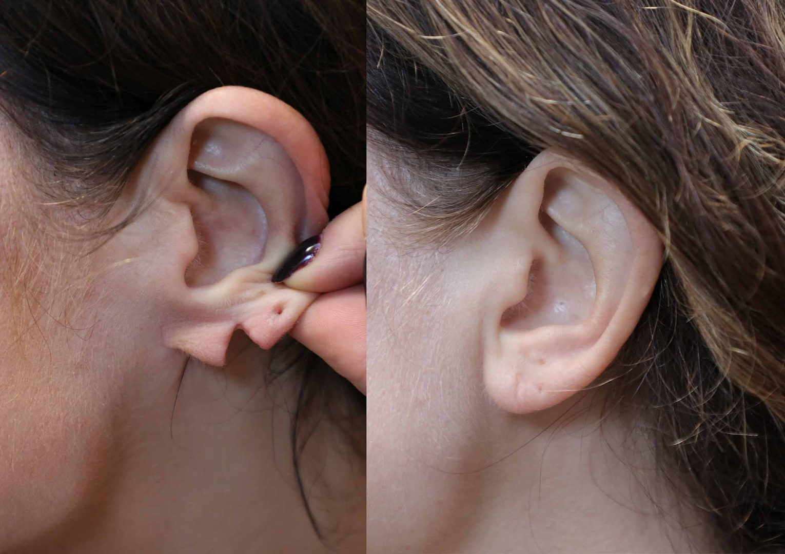 Earlobe Repair before and after