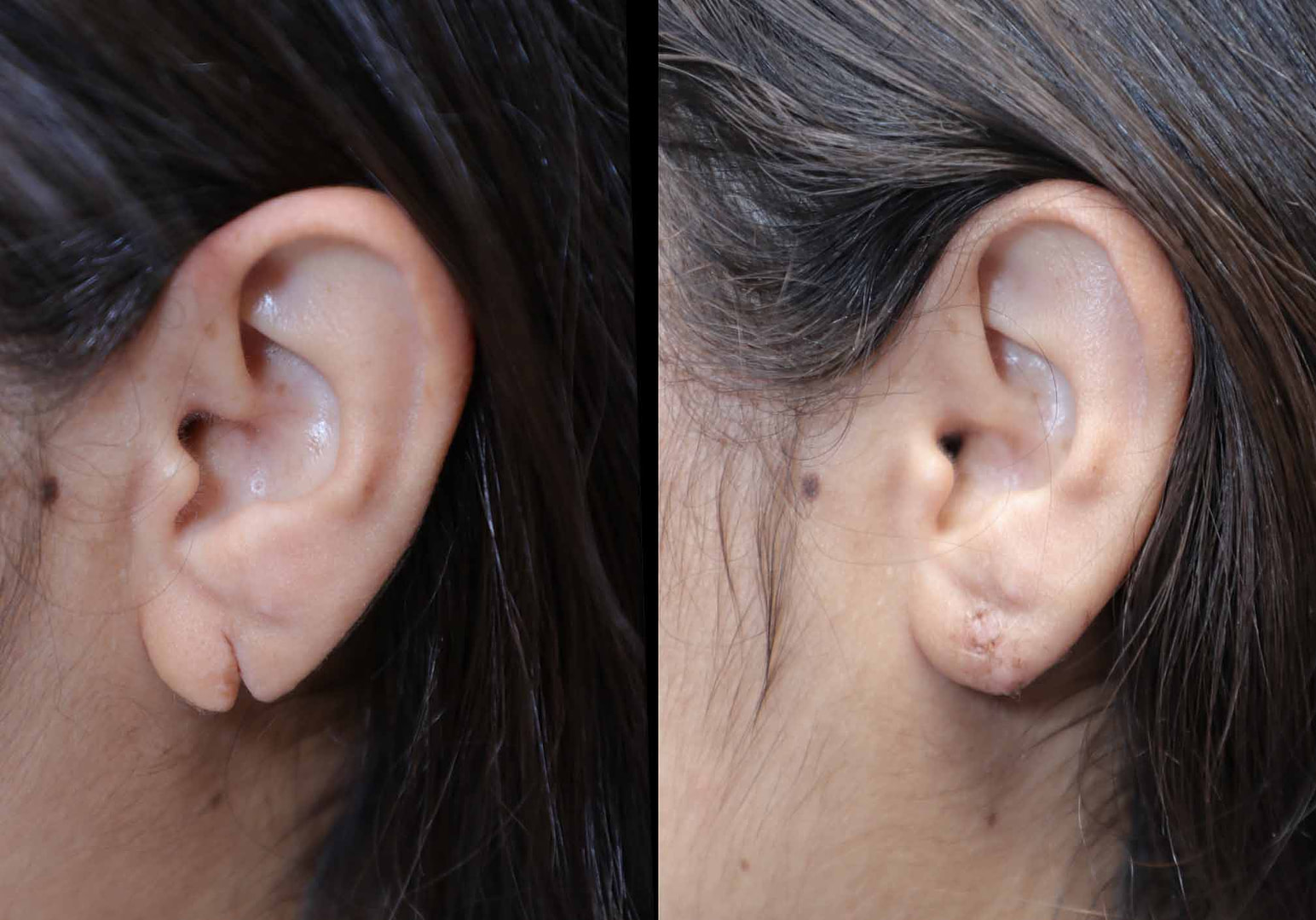 Earlobe Repair before and after
