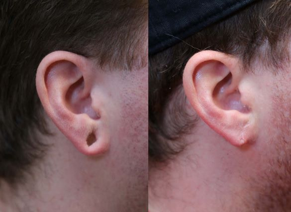 earlobe repair right side photo before and after