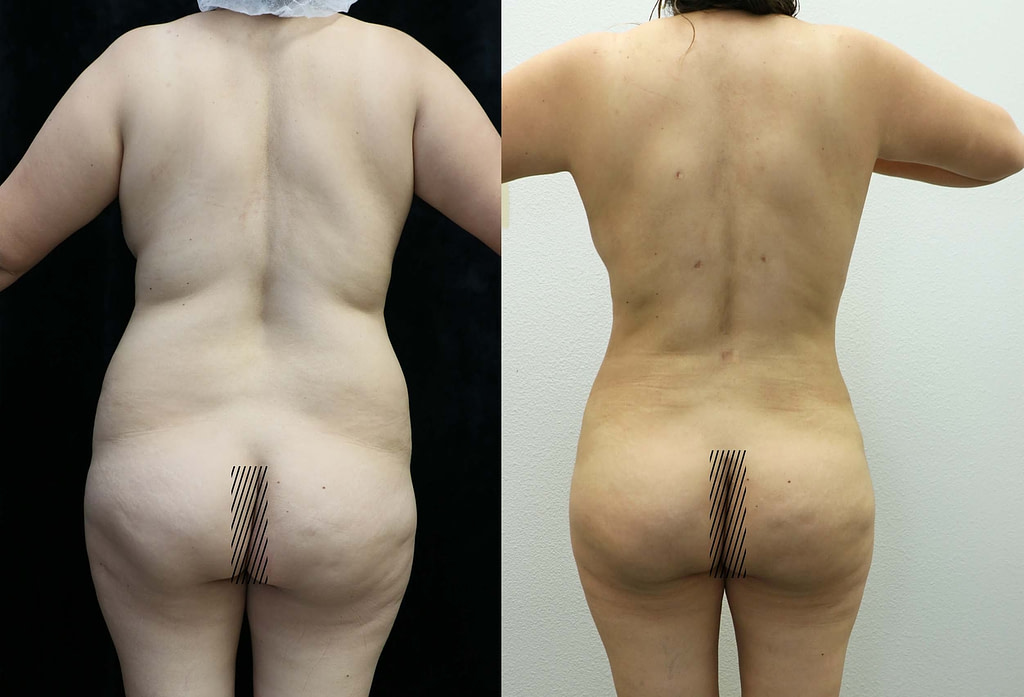 liposuction and fat transfer to buttocks