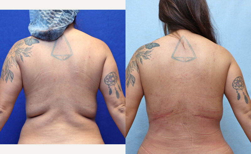 Excision of Excess Skin Bra Roll before and after, back view