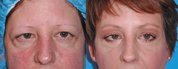 Eyelid Surgery Before & After Photos