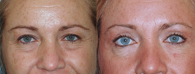 Eyelid Surgery Before & After Photos