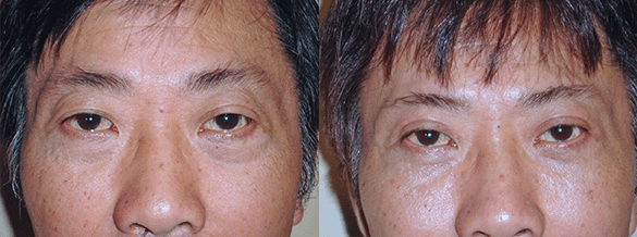 Eyelid Surgery Before & After Photos