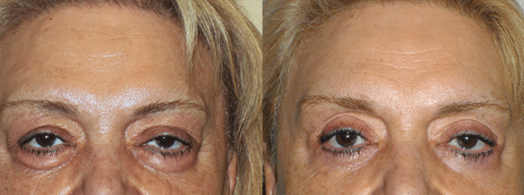Eyelid Surgery Before & After Photos