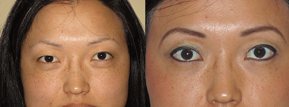 Eyelid Surgery Before & After Photos