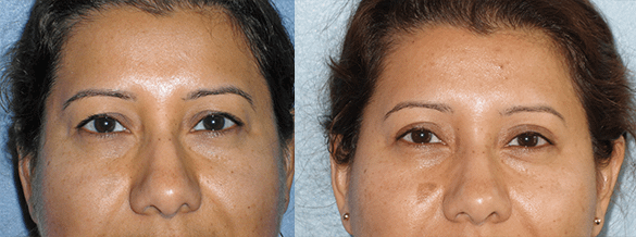 Eyelid Surgery Before & After Photos