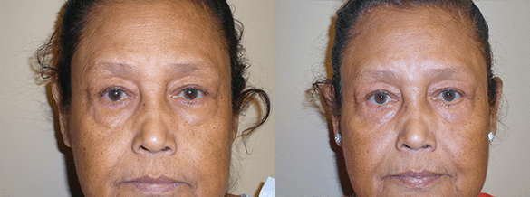 Eyelid Surgery Before & After Photos