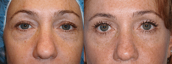 Eyelid Surgery Before & After Photos