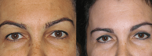 Eyelid Surgery Before & After Photos