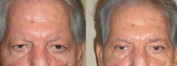 Eyelid Surgery Before & After Photos
