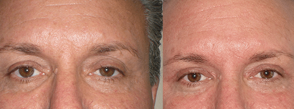 Eyelid Surgery Before & After Photos