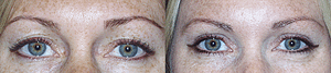 Eyelid Surgery Before & After Photos Front