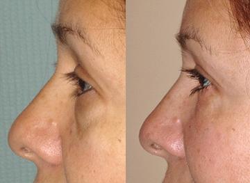 Under Eye Surgery (Lower Blepharoplasty) Before & After Photos Left