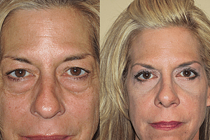 Eyelid Surgery Before & After Photos Front