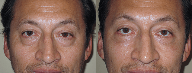Eyelid Surgery Before & After Photos