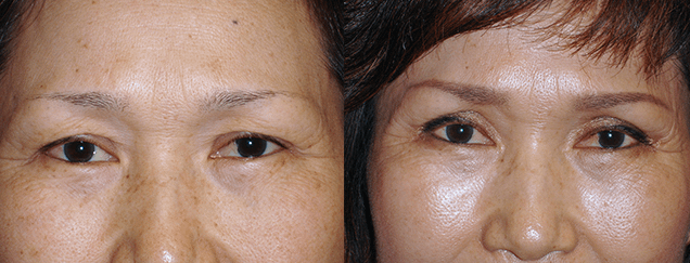 Eyelid Surgery Before & After Photos